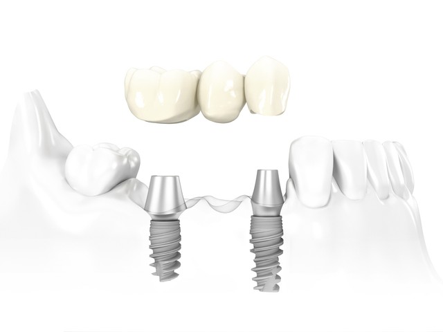 Мост из имплантов или отдельные коронки