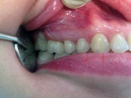 Протезирование на один или несколько зубов