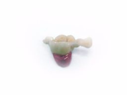 Протезирование на один или несколько зубов